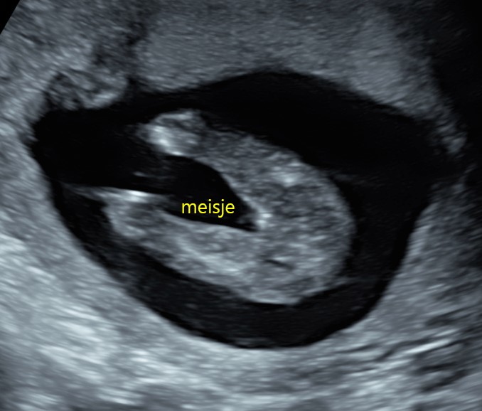Geslachtsvoorspelling echo voorbeeld
